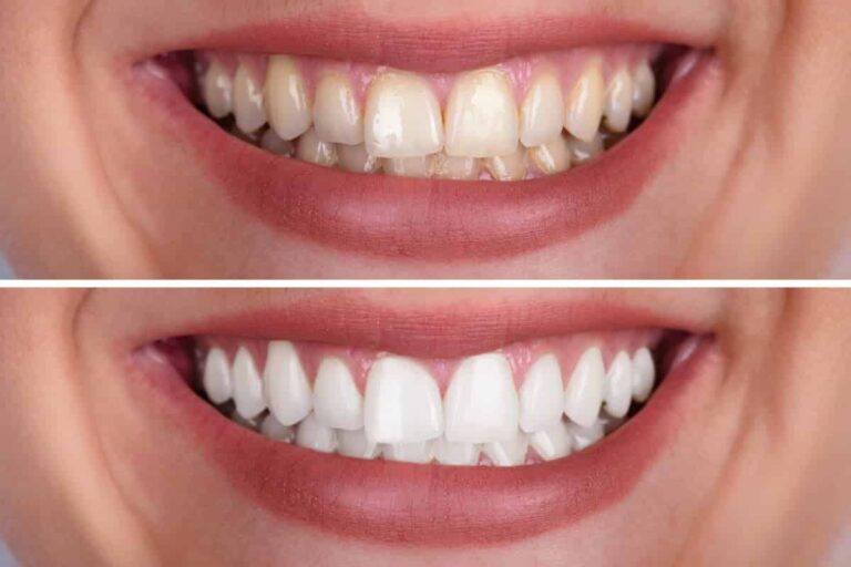 before and after teeth whitening comparison.